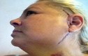 Người phụ nữ cấy ghép hàm titan 16.000 bảng Anh