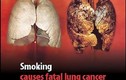 Ăn nhiều thịt làm tăng nguy cơ ung thư phổi