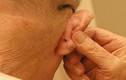 Dấu hiệu cơ bản của ung thư tai