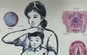 Mách mẹ cách xử trí khi trẻ bị viêm mũi họng