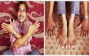 Clip người đàn ông có nhiều ngón tay chân nhất thế giới