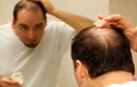 Cách chữa hói đầu ở nam giới hiệu quả nhất