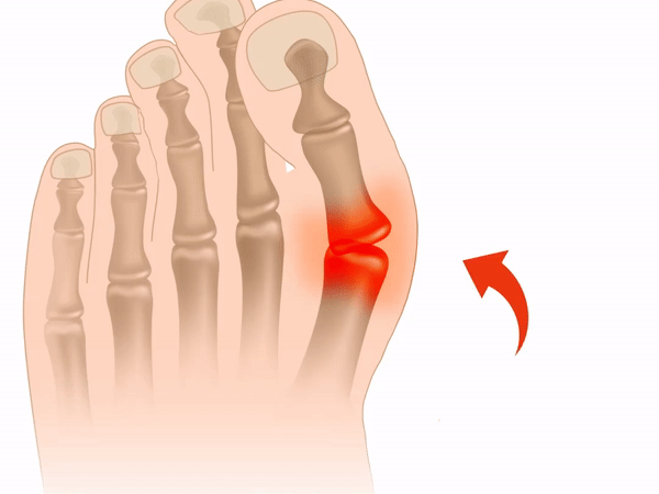 Video: Cách ngăn ngừa chứng vẹo ngón chân cái gây đau đớn