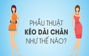 Video: Phẫu thuật kéo dài chân như thế nào?