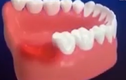 Trải nghiệm thực tế quá trình nhổ răng khôn trong chỉ với 7 phút tại Shinbi Dental