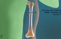 Cận cảnh quy trình phẫu thuật kéo dài chân