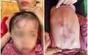 Bé gái 2 tuổi bị bạn học đánh, đạp dã man ở Bắc Giang