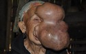 Bà lão 70 “sống không bằng chết” vì mang gương mặt quỷ