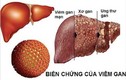 7 loại viêm nhiễm không nên coi thường vì dễ dẫn đến ung thư