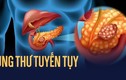 Cách phát hiện sớm ung thư tụy sâu trong ổ bụng