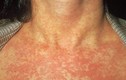 Cách phân biệt bệnh sởi và rubella