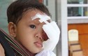 Xót xa bé gái 1 tuổi có đôi mắt chảy máu và mủ
