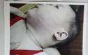 Bé gái 8 tháng tuổi nghi bị đánh chấn thương tại nhà trẻ