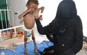Xót xa chùm ảnh về nạn đói khủng khiếp ở Yemen