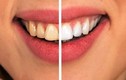 8 cách đơn giản ngừa sâu răng không cần dùng thuốc