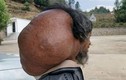 Kinh hãi khối u khổng lồ trên cổ người đàn ông suốt 50 năm