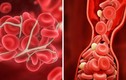 10 cách ngăn ngừa cục máu đông có thể cứu mạng sống