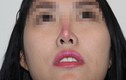 Kinh hoàng biến chứng nâng mũi: Lòi sụn, hoại tử lõm mũi