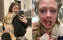 Cô gái sốc nặng khi bị chó cưng bất ngờ cắn sứt miệng
