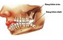 Nhổ răng khôn có thể gặp những nguy hiểm gì?