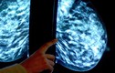 Bệnh nhân ung thư vú có thể không cần hóa trị?