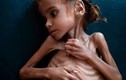 Bé gái da bọc xương gây chấn động về nạn đói ở Yemen qua đời