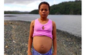 Thiếu nữ có bụng to bất thường khiến dân làng nghi mang thai với cá