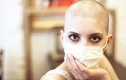 Người bệnh ung thư hóa trị nên làm gì khi tóc, lông rụng