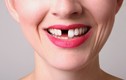 Những thói quen nguy hại khiến răng biến dạng khủng khiếp