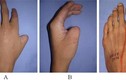 Hy hữu ca phẫu thật đưa ngón chân lên thay thế ngón tay cái