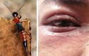 Mắt sưng đỏ, ngứa rát vì dính dịch của kiến ba khoang