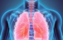 Mắc bệnh viên phổi "dễ như chơi" bởi lý do thường gặp