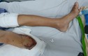 Bác sĩ xót xa cắt bỏ chân bệnh nhi sau 4 lần phẫu thuật không thành công