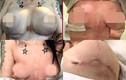 Ra nước ngoài nâng ngực, cô gái trẻ phải nạo vét cắt bỏ 2 bên vú