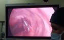 Phẫu thuật rút đinh dài 12cm xuyên qua đỉnh phổi