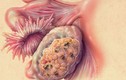 4 điều ít biết về ung thư cổ tử cung