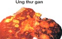 Thêm dấu hiệu đáng ngờ của ung thư gan