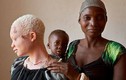 Khám phá gây đau lòng về người bạch tạng ở Tanzania 