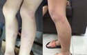 Điểm nóng 24h: Học sinh bị giáo viên đánh tím chân