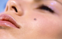 Lý giải những nốt ruồi trên mặt và cơ thể con người