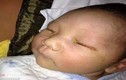 Một em bé bị mù mắt vì đèn flash máy ảnh