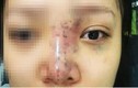 Công an vào cuộc vụ spa tiêm filler làm nữ sinh 20 tuổi mù mắt