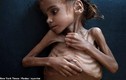 Chấn động hình ảnh trẻ em da bọc xương vì nạn đói ở Yemen