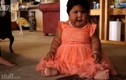 Bệnh lạ khiến em bé 10 tháng lớn bằng trẻ 5 tuổi
