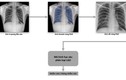 VinBrain phát hành sách trắng về ứng dụng AI chẩn đoán bệnh lao