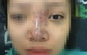 Nữ sinh bị mù mắt khi tiêm filler: Dấu hiệu đáng ngờ bên trong spa