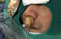 10 năm điếc ngửi, bác sĩ lôi ra thủ phạm chình ình trong mũi 