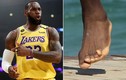 Ngón chân biến dạng của các VĐV bóng rổ