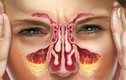 8 biện pháp giúp F0 giảm ngạt mũi, tránh khô họng, đau họng