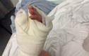 Kinh hoàng bệnh lạ khiến người mẹ phải cắt từng phần của ngón tay suốt 6 năm